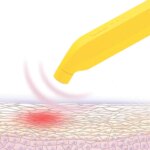 Detalhe da ponta de pulso térmico do curativo elétrico para picadas de insetos